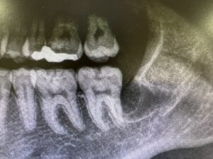 深い位置で横向きの親知らずを抜歯した後