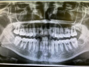 若い方の根未完成の親知らずの抜歯後