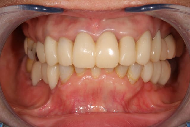 歯周病治療、根管治療、インプラント埋入後、仮歯で噛み合わせの変更（咬合挙上）を行い経過観察中