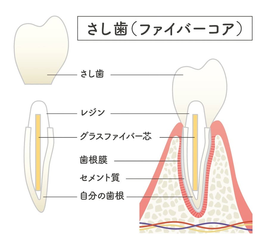 ファイバーコア（土台）