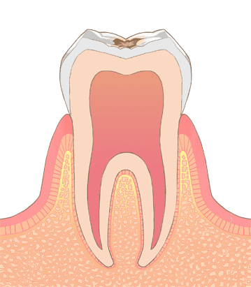 C1（初期虫歯）