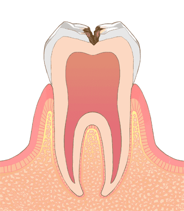 C2（エナメル質から象牙質までの虫歯）