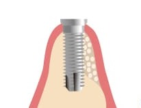 GBR（Guided Bone Regeneration）3