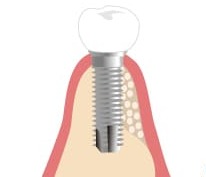 GBR（Guided Bone Regeneration）4