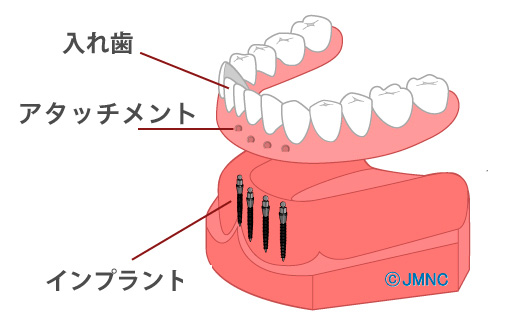 インプラントオーバーデンチャーのメカニズム