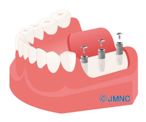 インプラント埋入2