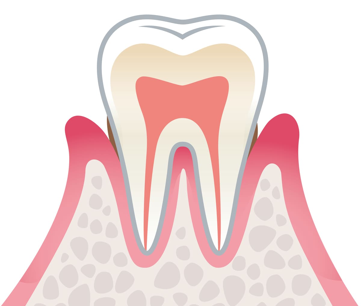 軽度歯周炎：歯周ポケットの形成