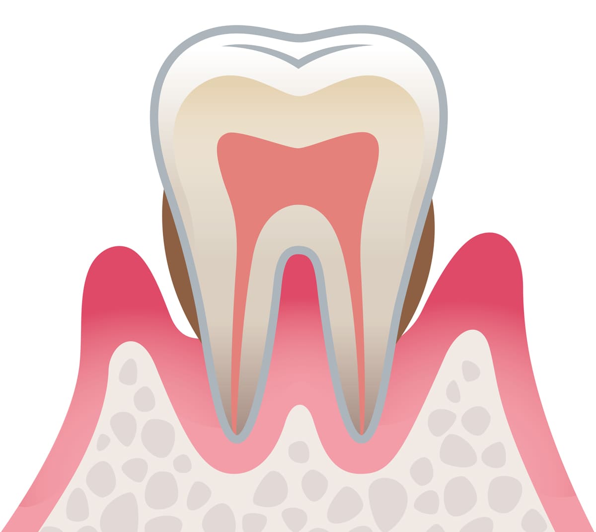 中度歯周病：歯槽骨の破壊