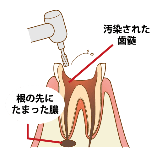 1. 虫歯の診断と切削