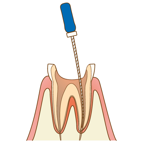 2. 根管形成と清掃