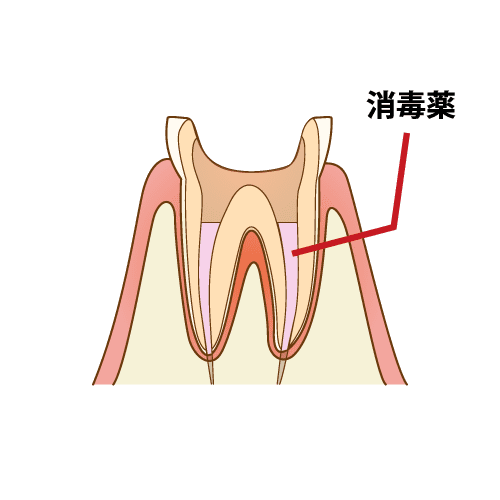 3. 根管の殺菌洗浄