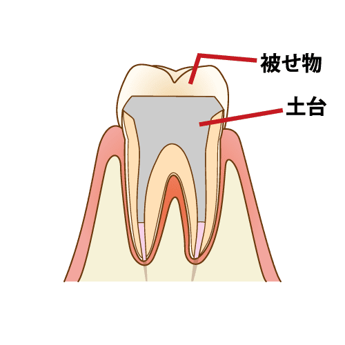 5. 根管の密封と支台築造