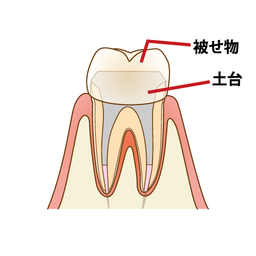 6. 仕上げに被せ物の装着