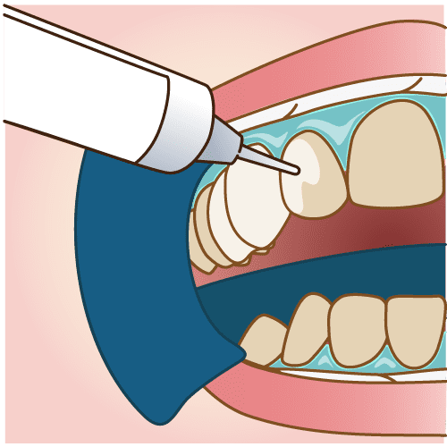 3：ホワイトニング剤の塗布