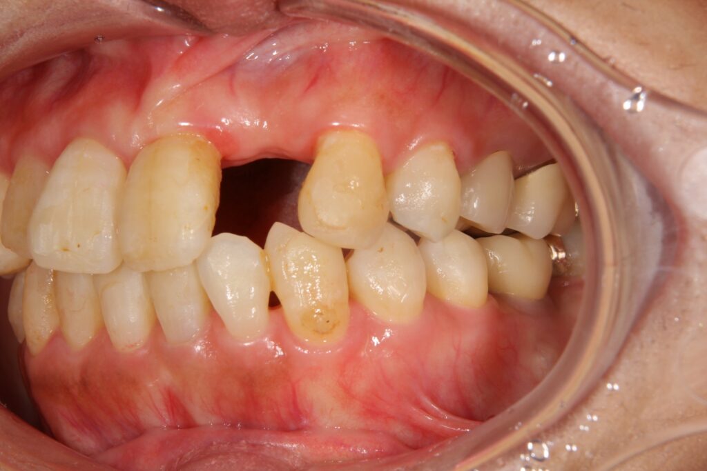 左上の前歯が欠損