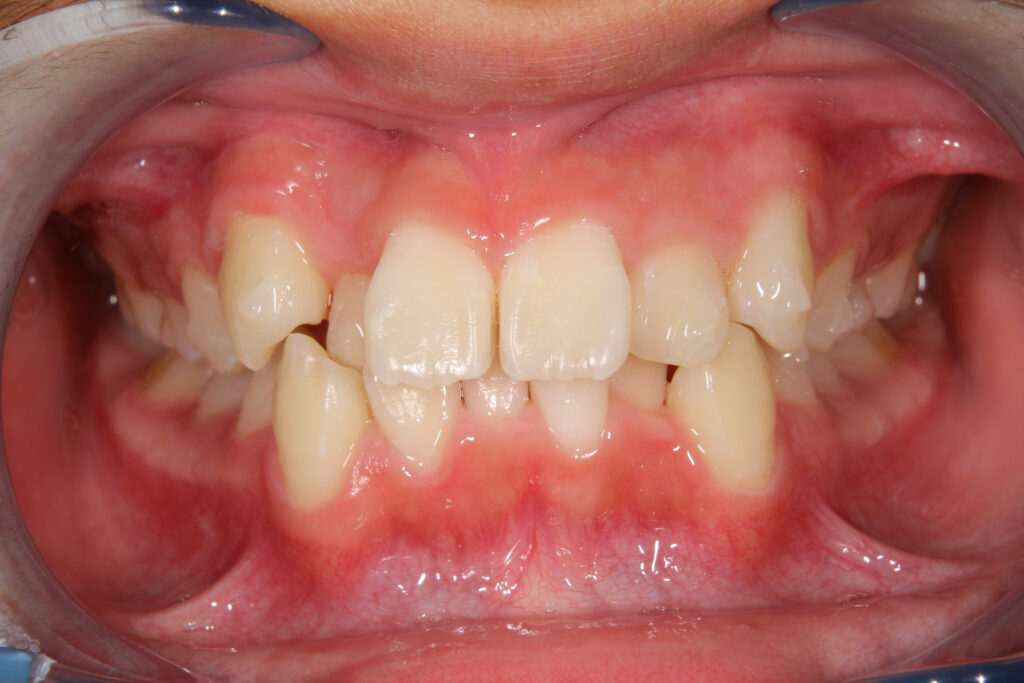 全体的に歯並びが悪い状態